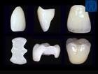 Ceramic Restorations